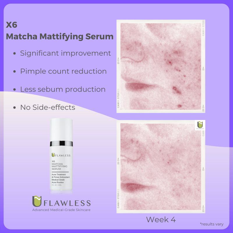 X6 Acne Routine | Advanced Acne Treatment | Natural Ingredients