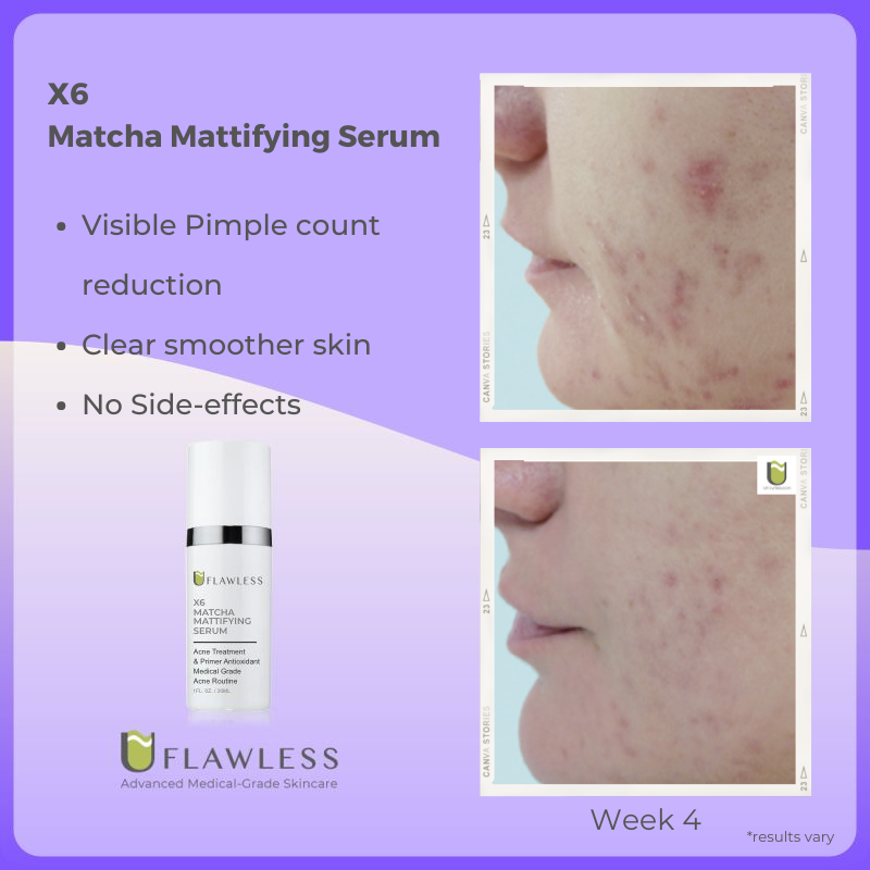 X6 Acne Routine | Advanced Acne Treatment | Natural Ingredients